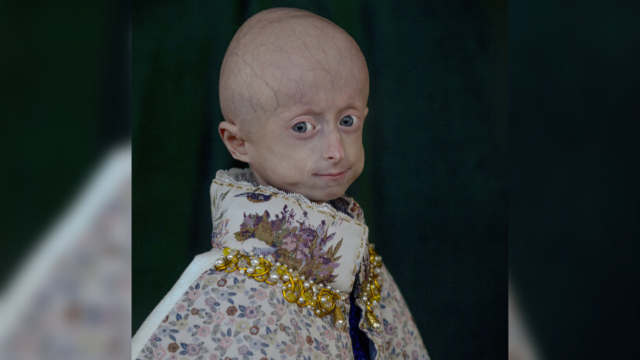 Журнал «Vogue» опублікував фото вінничанки Ірини Химич, яка хворіла на прогерію